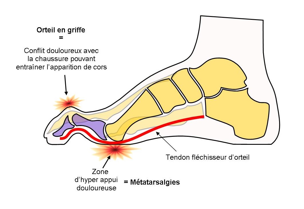 Pied creux 2024 chaussures à talons